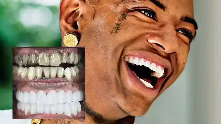 Soulja Boy teeth Black, What Happened To Soulja Boy teeth